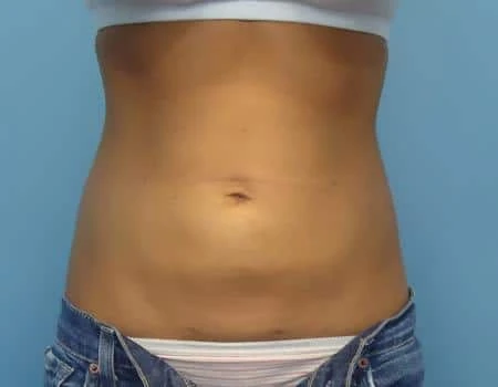 Smartlipo Before & After Case 4337
