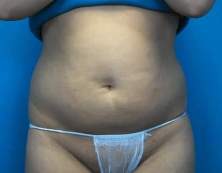 Smartlipo_04_b1