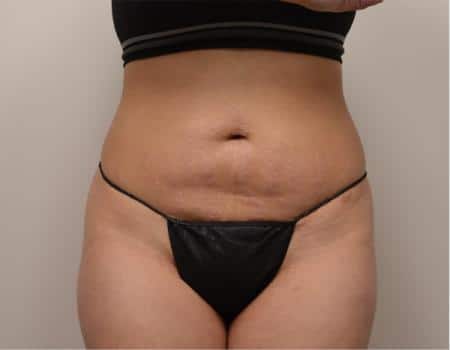 TUMMY-TUCK-C10-B1