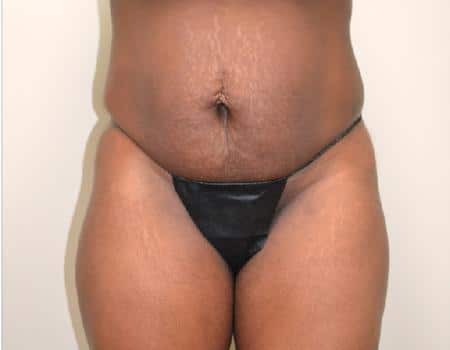 TUMMY-TUCK-C11-B1