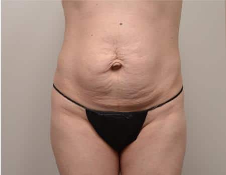 TUMMY-TUCK-C12-B1