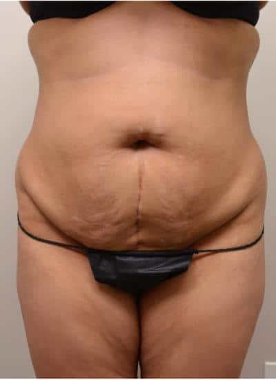 TUMMY-TUCK-C13-B1