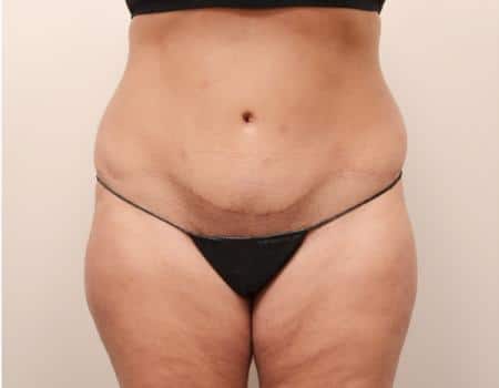 Tummy Tuck Before & After Case 3779