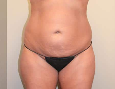 TUMMY-TUCK-C14-B1