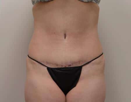 TUMMY-TUCK-C15-A1