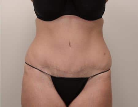 Tummy Tuck Before & After Case 3765