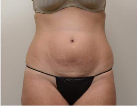 TUMMY-TUCK-C16-B1
