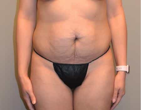 TUMMY-TUCK-C17-B1