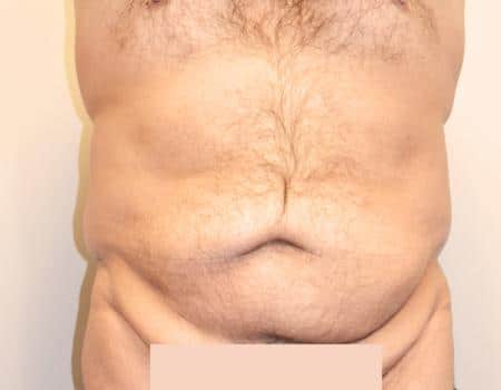 TUMMY-TUCK-C18-B1