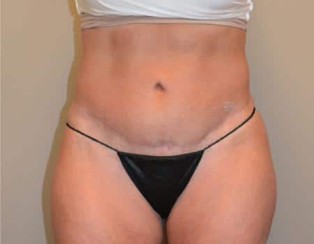 Tummy Tuck Before & After Case 3744