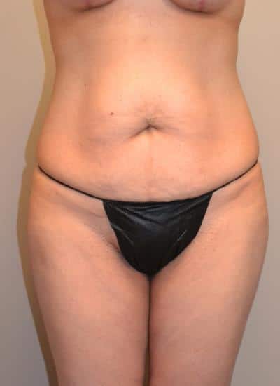 TUMMY-TUCK-C20-B1
