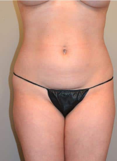 TUMMY-TUCK-C21-B1