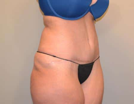Tummy Tuck Before & After Case 3716