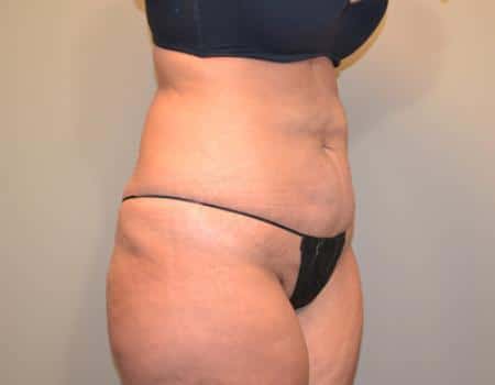 TUMMY-TUCK-C23-B1