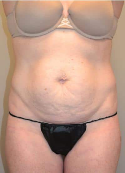 TUMMY-TUCK-C24-B1