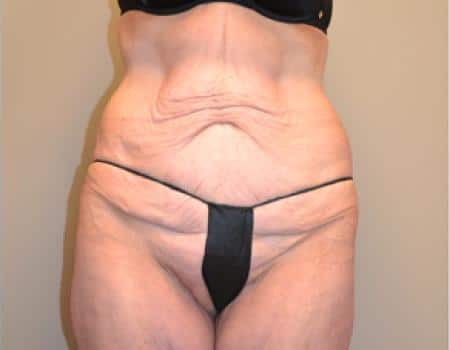 TUMMY-TUCK-C26-B1
