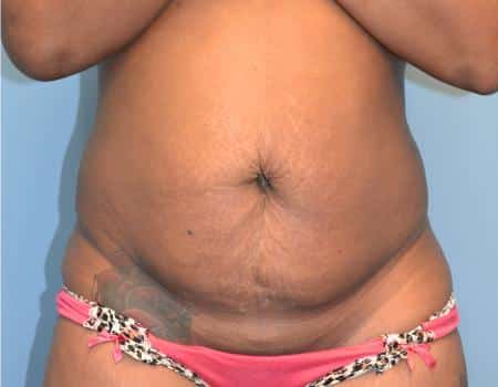 TUMMY-TUCK-C28-B1