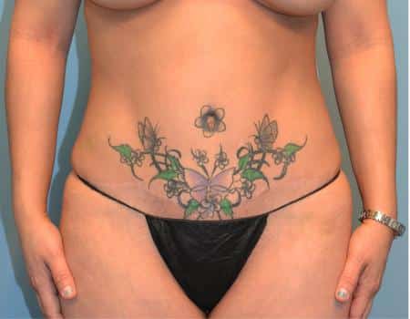 Tummy Tuck Before & After Case 3676