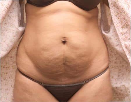TUMMY-TUCK-C29-B1
