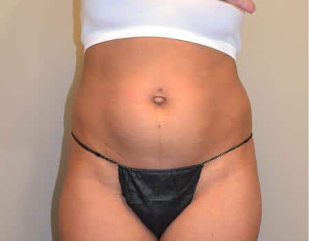TUMMY-TUCK-C30-B1