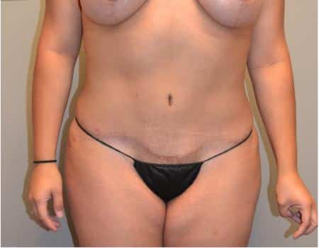Tummy Tuck Before & After Case 3662