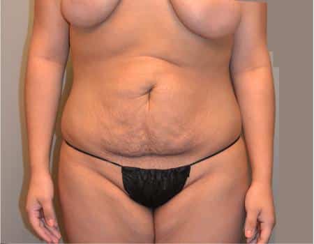 TUMMY-TUCK-C31-B1