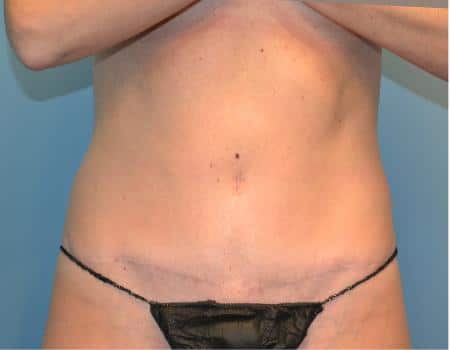 Tummy Tuck Before & After Case 3648