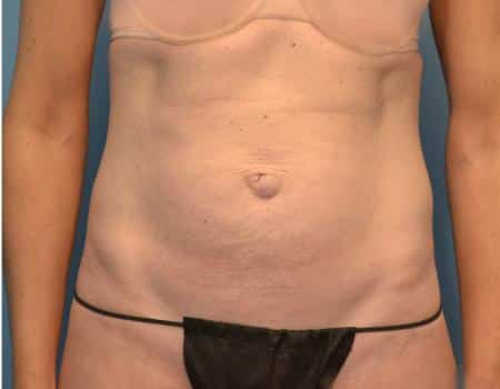 TUMMY-TUCK-C33-B1