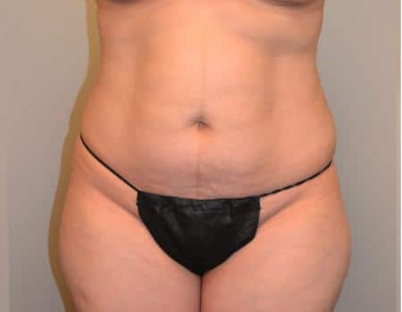 TUMMY-TUCK-C34-B1