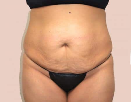 TUMMY-TUCK-C7-B1