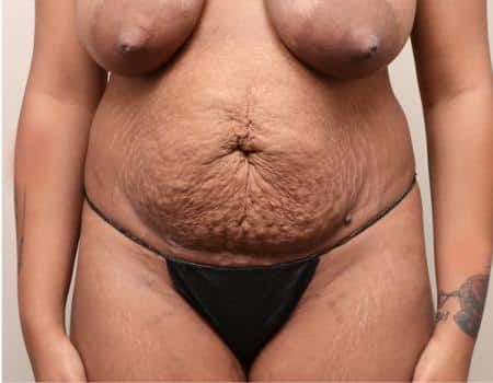 TUMMY-TUCK-C8-B1