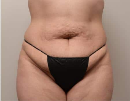 TUMMY-TUCK-C9-B1