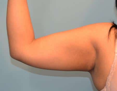 Thigh-Arm-Lifts-C2-B1