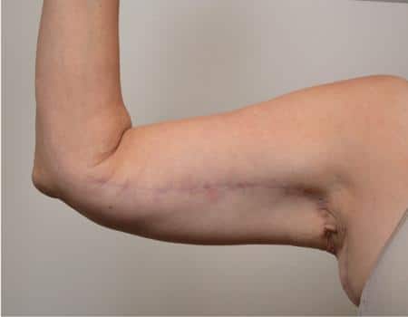 Arm Lift Before & After Case 4050