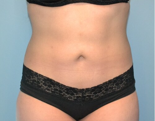 Smartlipo Before & After Case 4355