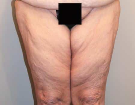 thigh-lift33-c4-b1