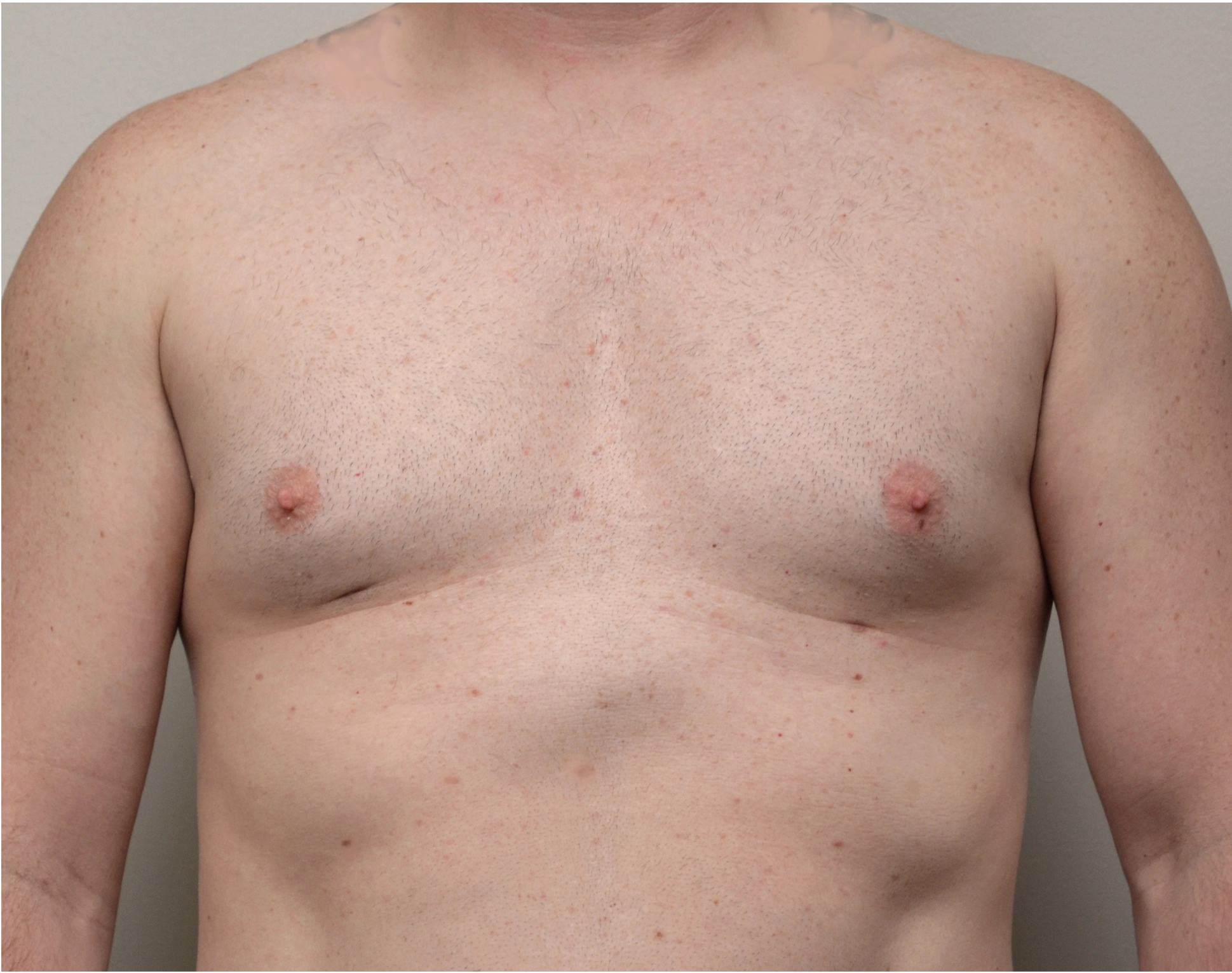 Gynecomastia Before & After Case 9