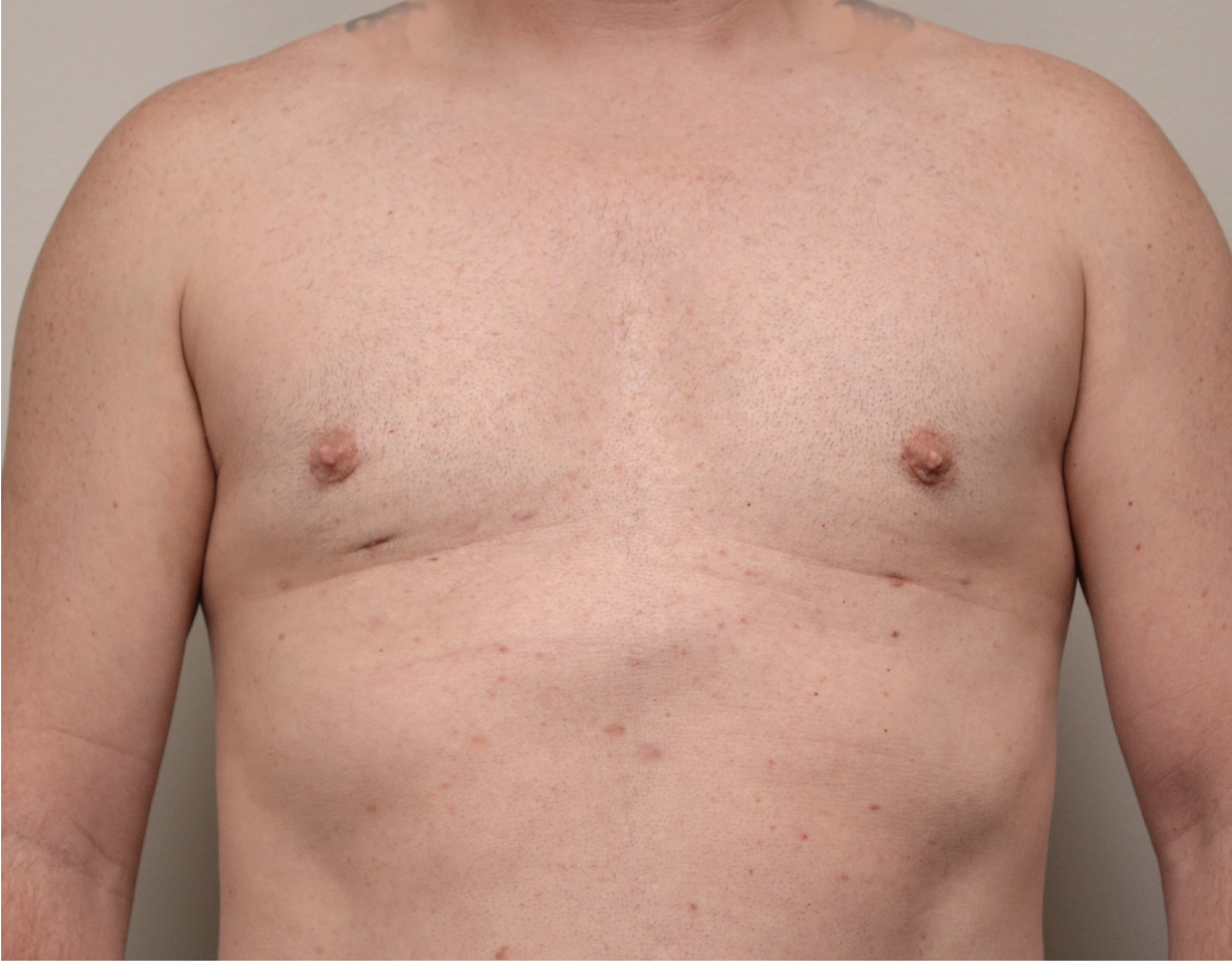 Gynecomastia Before & After Case 9
