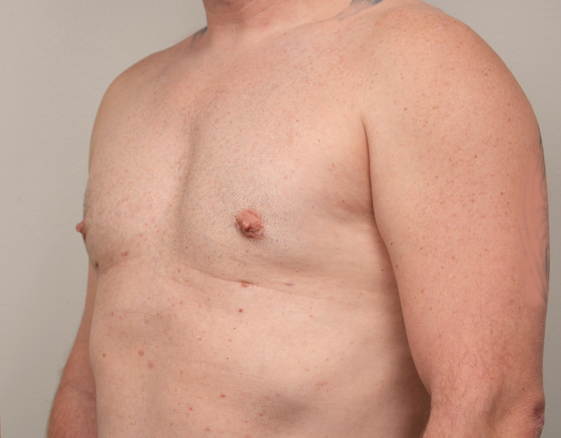 Gynecomastia Before & After Case 9