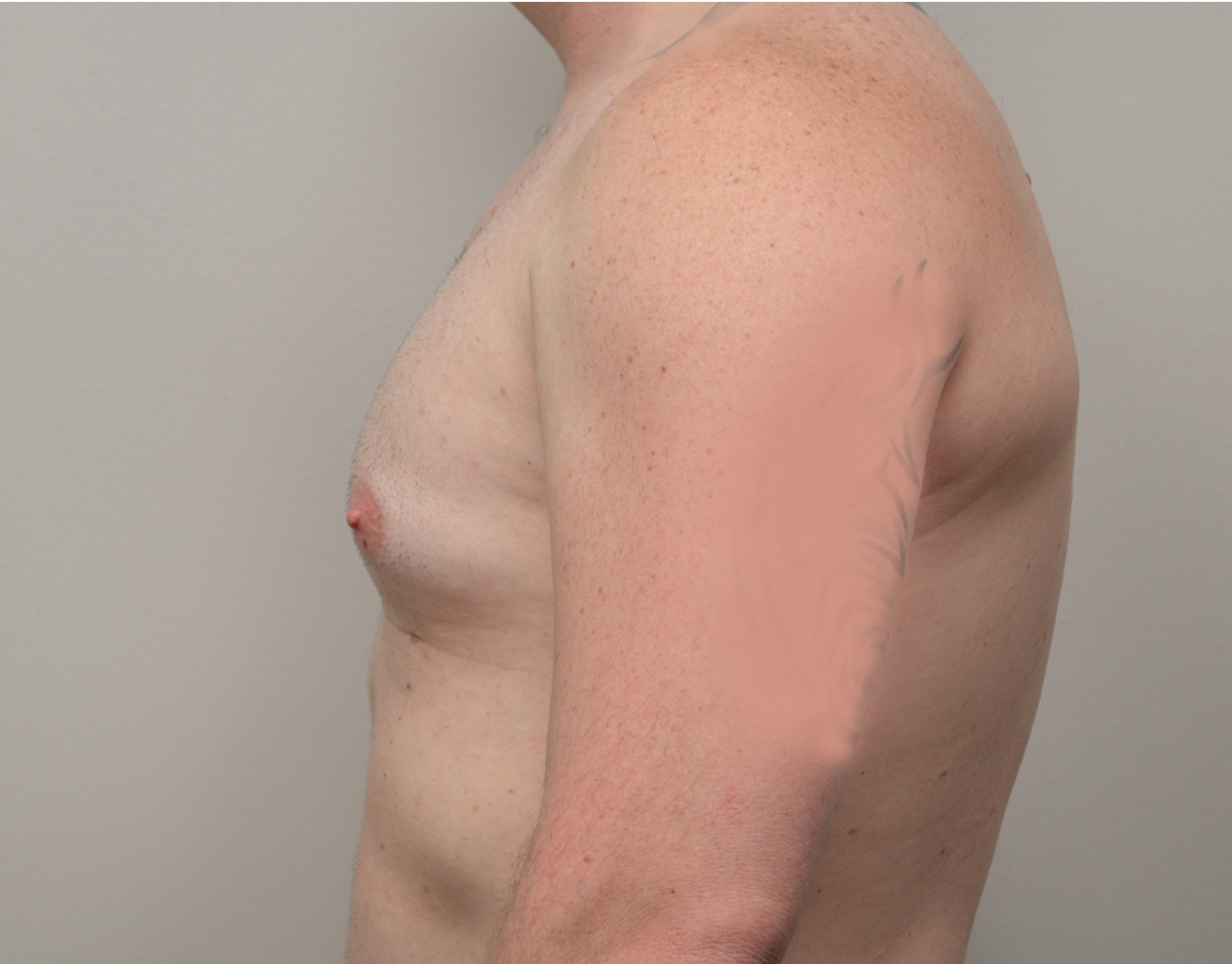 Gynecomastia Before & After Case 9