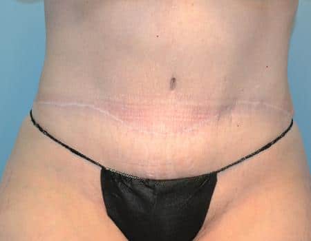 Tummy Tuck Before & After Case 3853