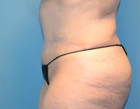 Tummy Tuck Before & After Case 3853