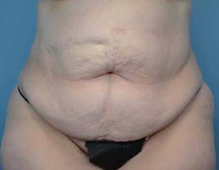 Tummy Tuck Before & After Case 3853