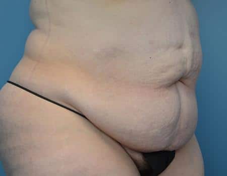 Tummy Tuck Before & After Case 3853