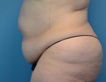 Tummy Tuck Before & After Case 3853