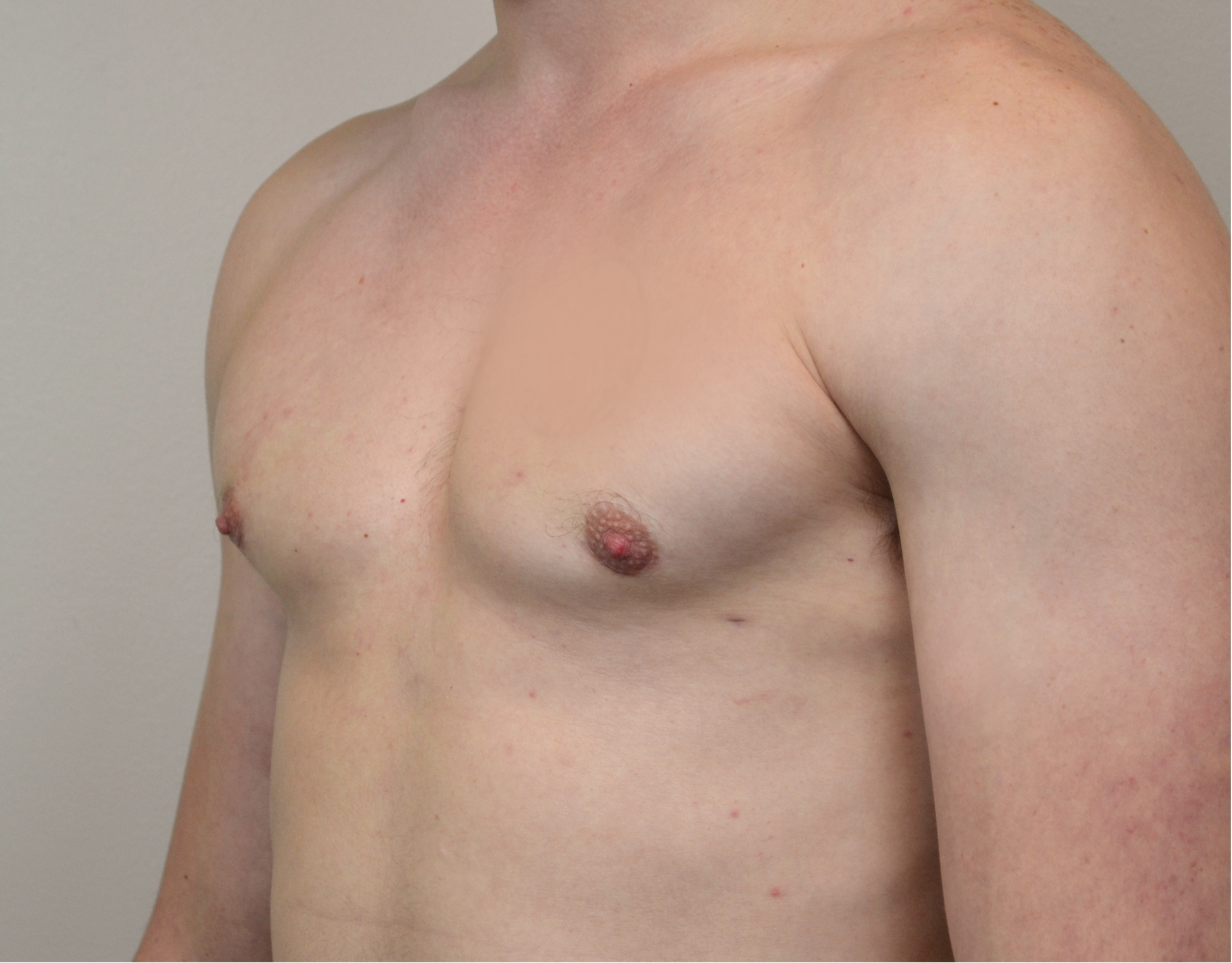 Gynecomastia Before & After Case 25