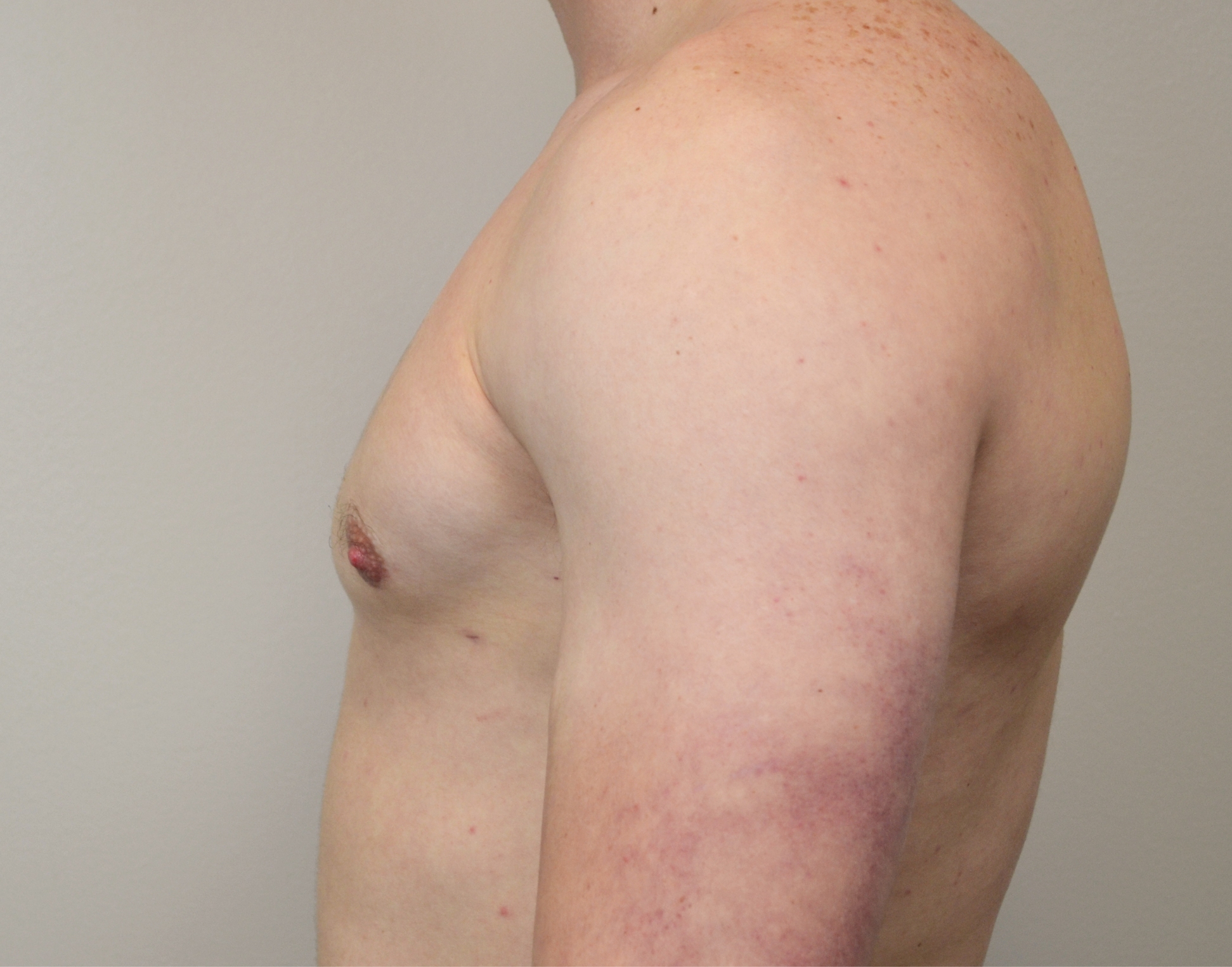 Gynecomastia Before & After Case 25