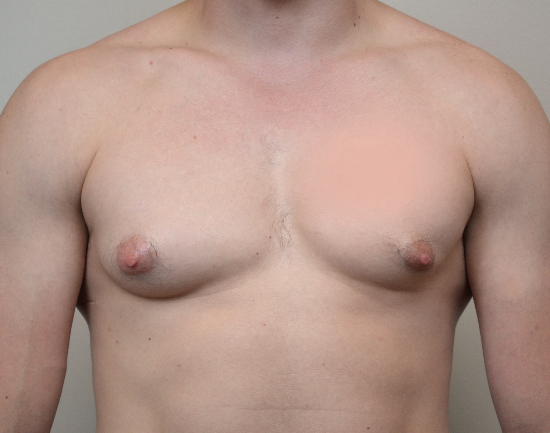 Gynecomastia Before & After Case 25
