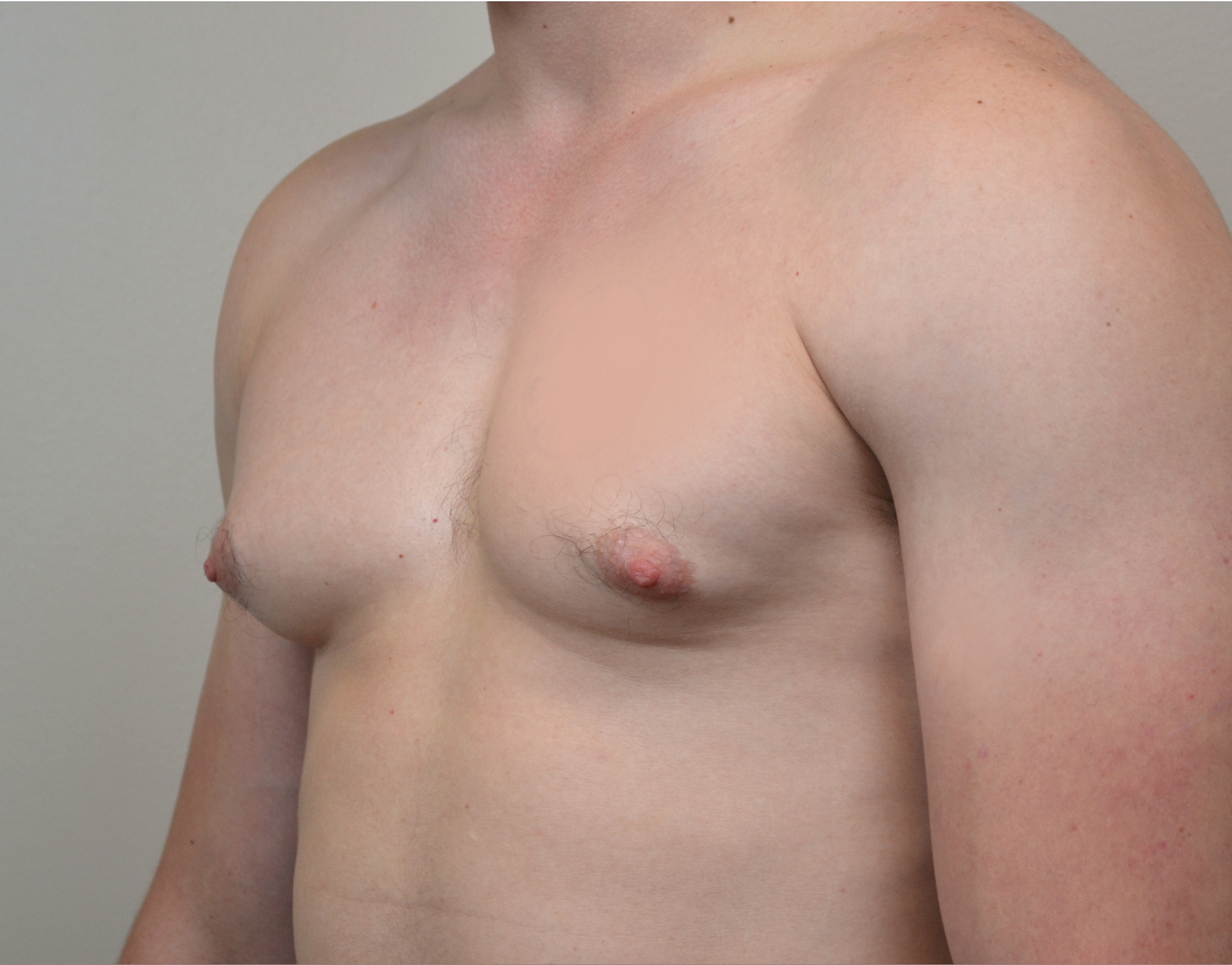 Gynecomastia Before & After Case 25