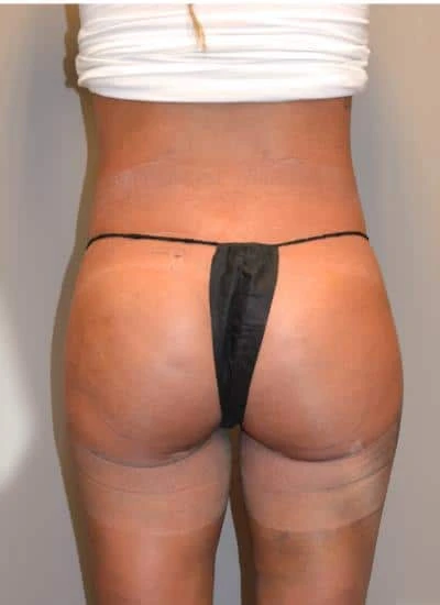 Brazilian Butt Lift With Fat Transfer Before & After Case 3957